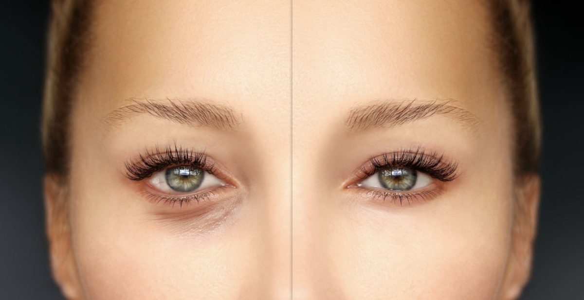 blepharoplastie-inferieure