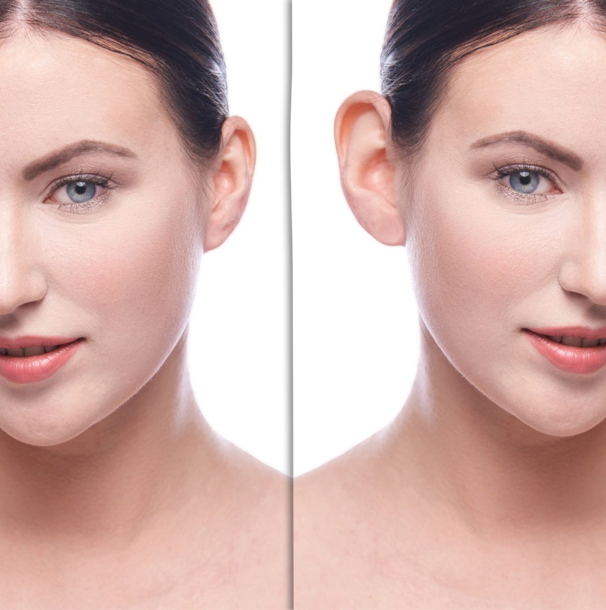 oreilles-decollees-2