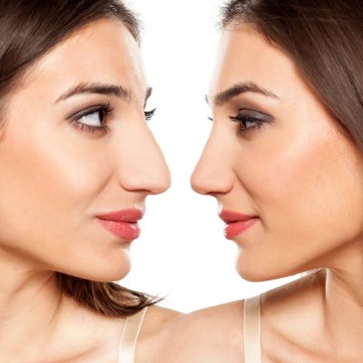 rhinoplastie-1