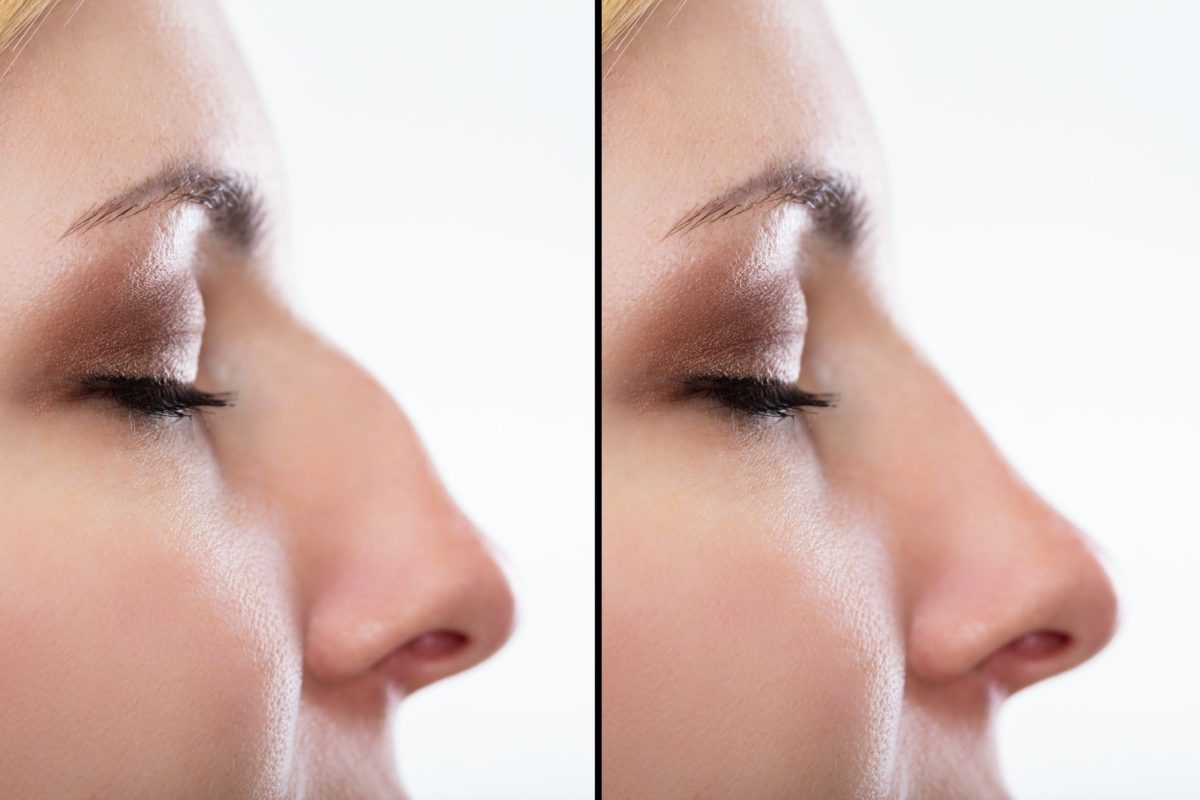 rhinoplastie-2